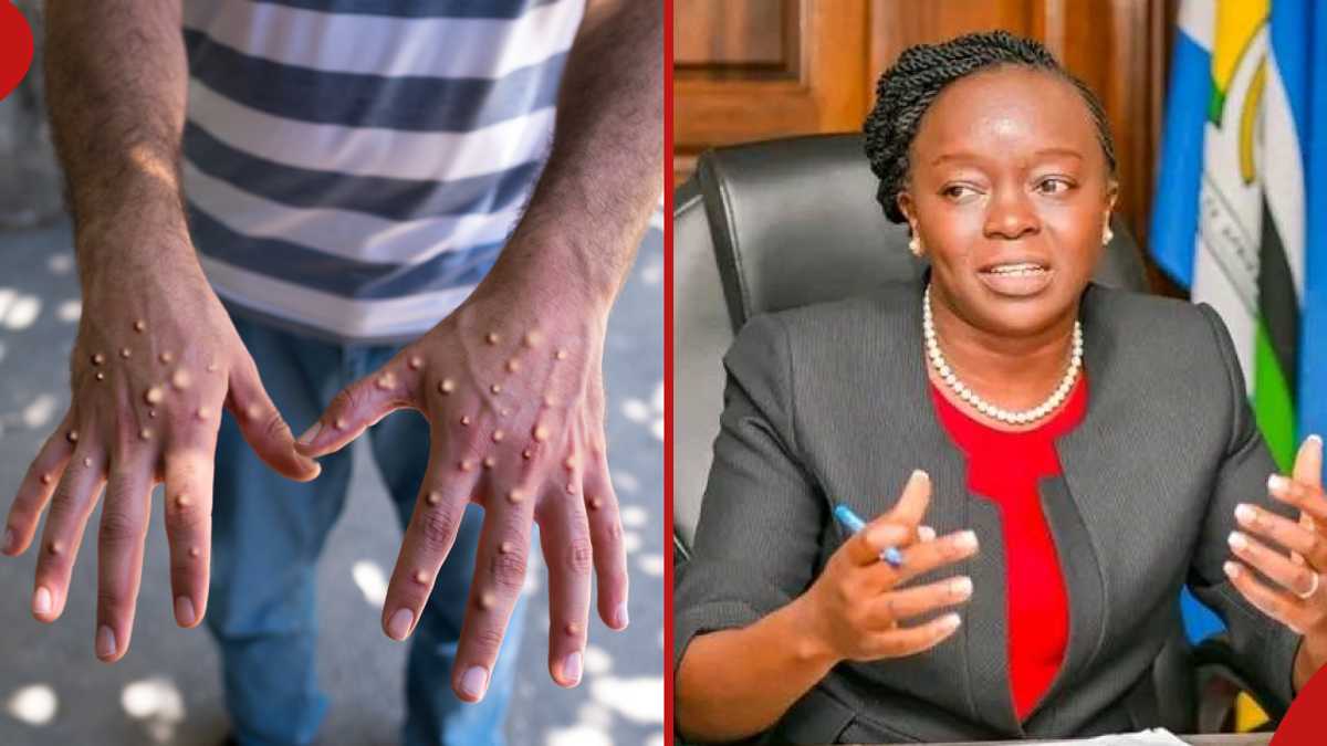 Mpox : le gouvernement kenyan confirme qu'il n'y a pas de cas actif et que le patient est complètement rétabli