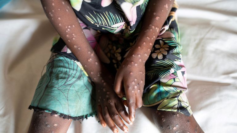 Mpox is not under control in Africa, warns Africa CDC