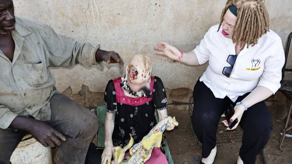 Persons with albinism face severe health crisis in Zimbabwe as lack of access to care claims another life
