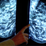 Breast cancer diagnoses and deaths expected to surge worldwide, says WHO
