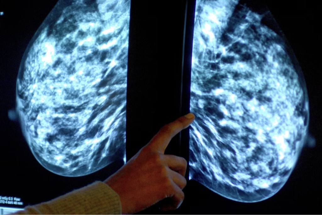 Breast cancer diagnoses and deaths expected to surge worldwide, says WHO
