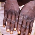 Le département de la santé prévoit une précaution supplémentaire après qu'il enregistre 3 nouveaux cas de MPOX