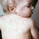 Gauteng Health Dept exhorte les parents à protéger les enfants contre l'épidémie de la rougeole