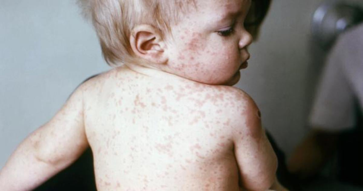 Gauteng Health Dept exhorte les parents à protéger les enfants contre l'épidémie de la rougeole