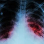 Zimbabwe calls for sustainable domestic financing to curb tuberculosis
